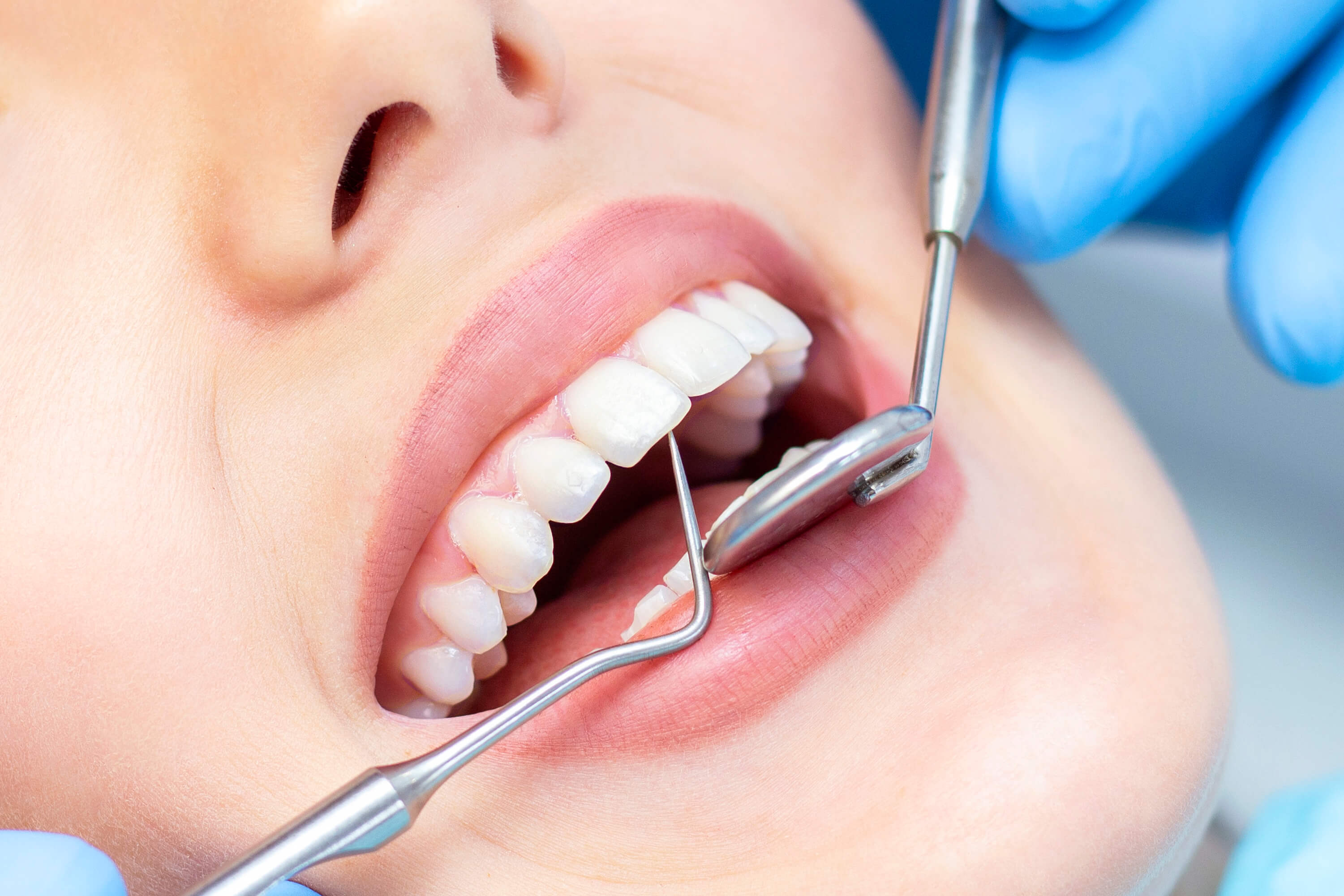 Clean dental Plague (scaling) easily at Dental Clinic Circle Dental Bali