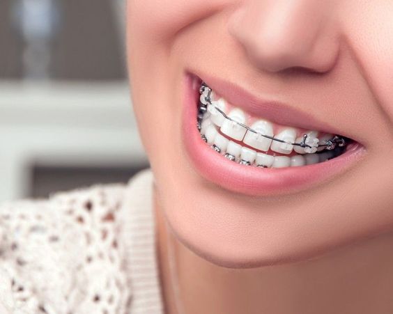 Kapan Waktu yang Tepat untuk Pasang Kawat Gigi? Cek Penjelasan dari Circle Dental Bali