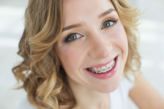 Pasang Kawat Gigi di Usia Berapa - Panduan Lengkap Pasang Kawat Gigi by Dental Klinik Circle Dental Bali