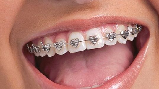 Pasang Kawat Gigi hingga Scaling di Dental Klinik Circle Dental Bali